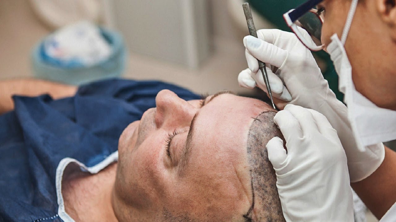 Hair Transplant in Islamabad