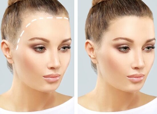 زراعة الشعر في دبي
