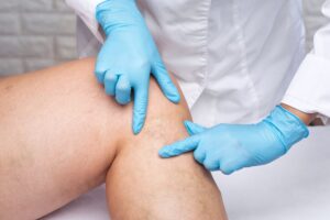 Sclerotherapy Abu Dhabi