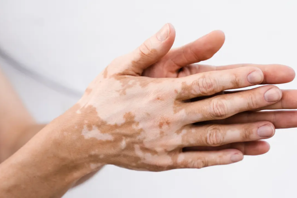 Vitiligo treatment in Abu Dhabi