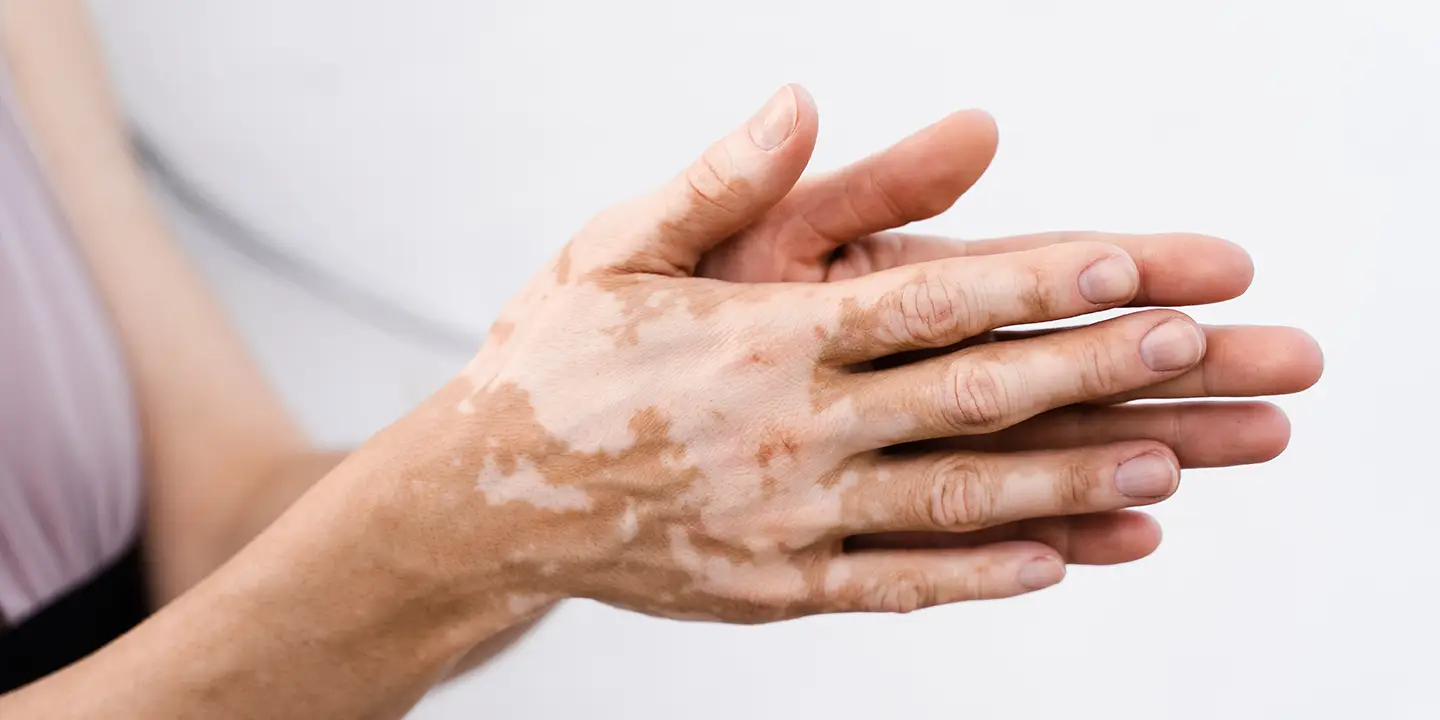 Vitiligo treatment in Abu Dhabi