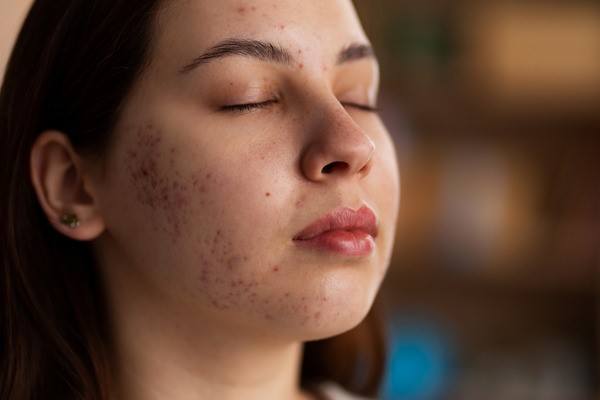 Laser Acne Scar treatment in Abu Dhabi