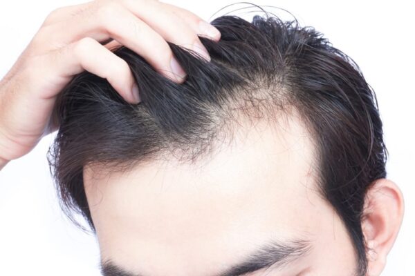 Hybrid Hair Transplant in Abu Dhabi