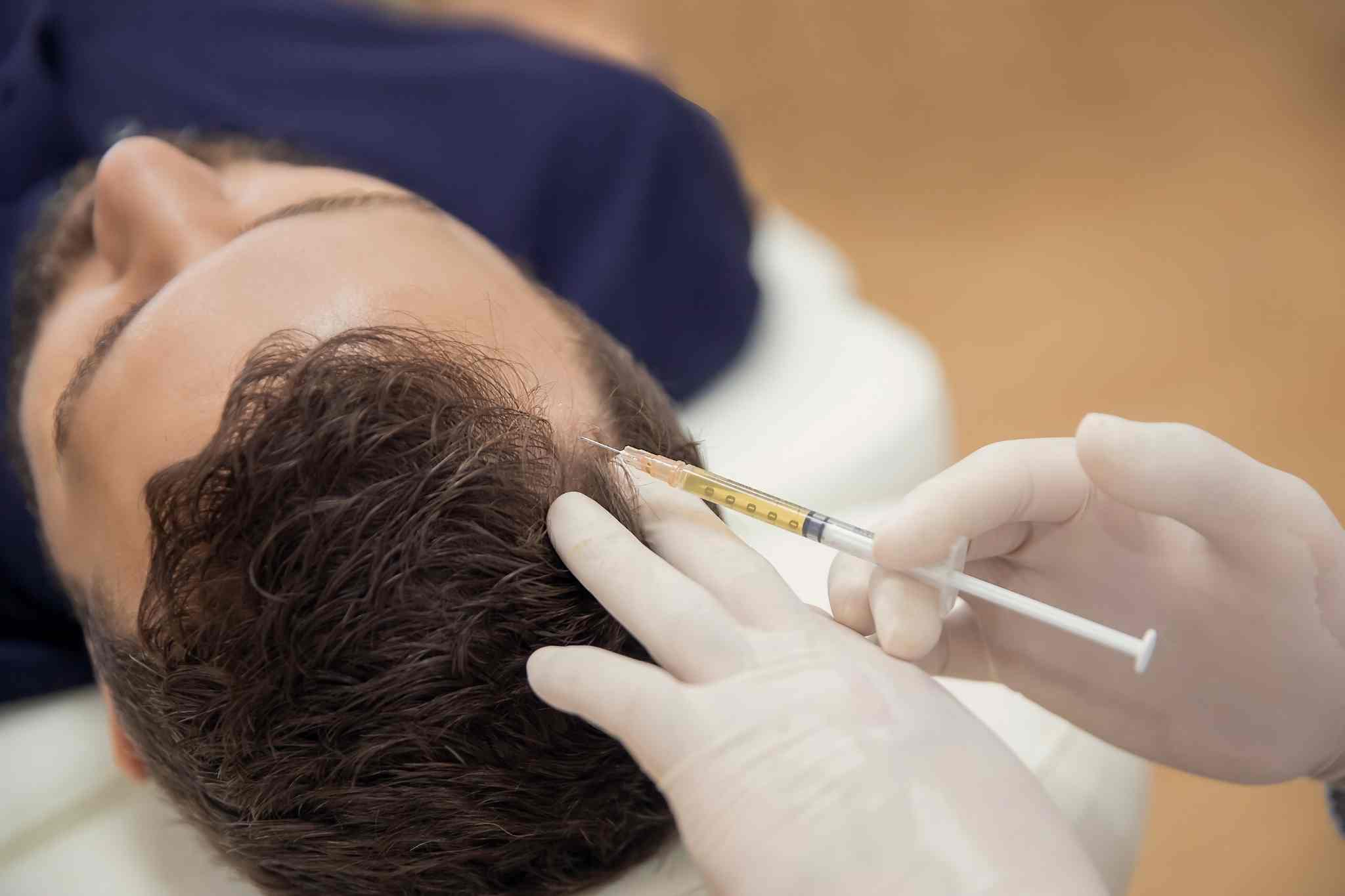 Stem Cell Hair Transplant in Abu Dhabi