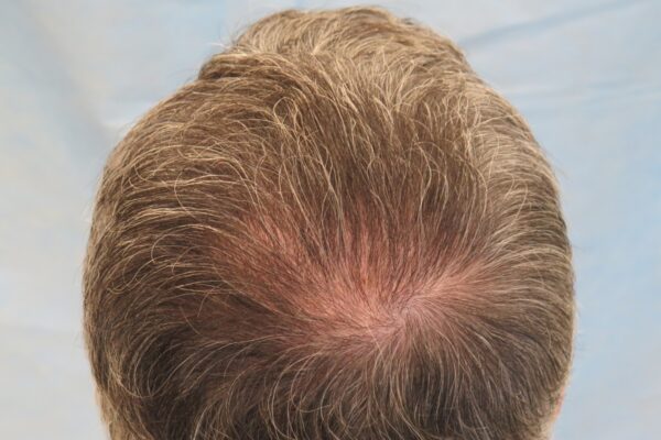 Scarless hair transplant in Abu Dhabi