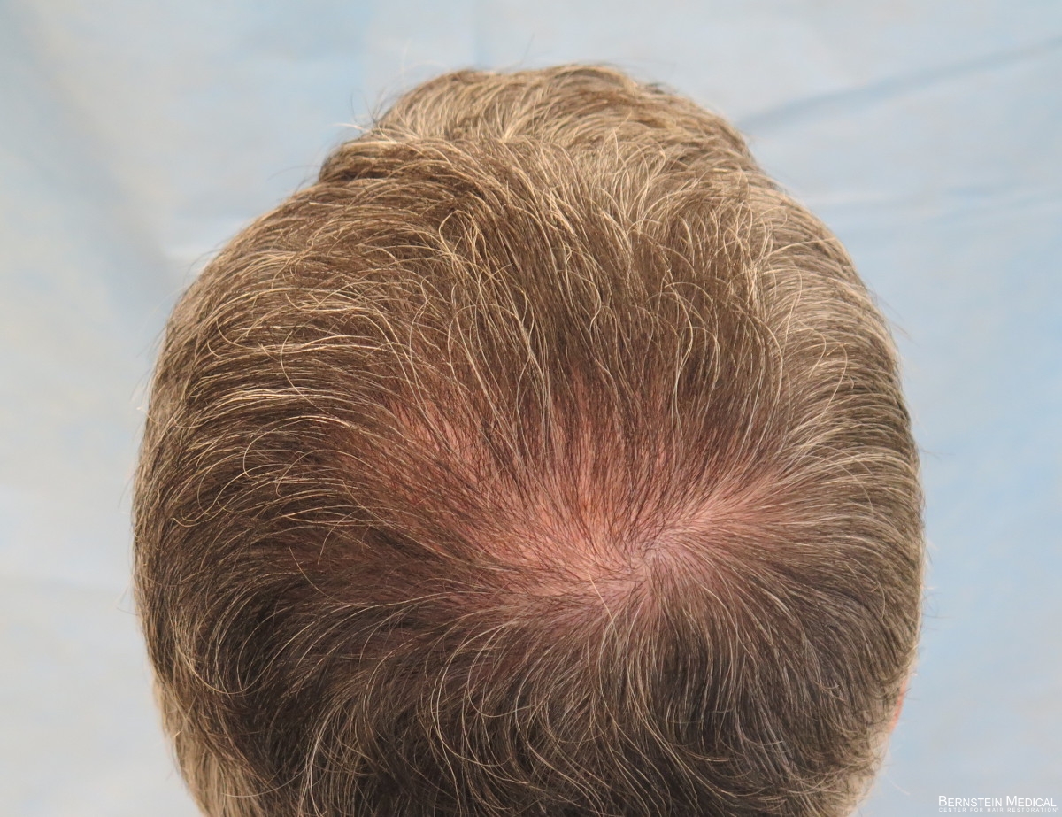 Scarless hair transplant in Abu Dhabi