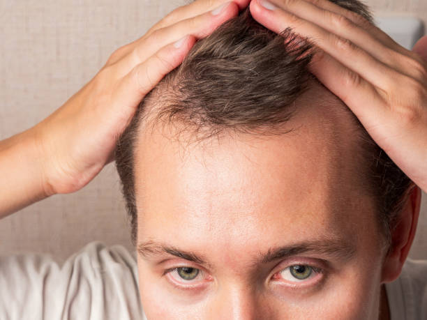 Is GFC Treatment for Hair Right for Chronic Hair Fall