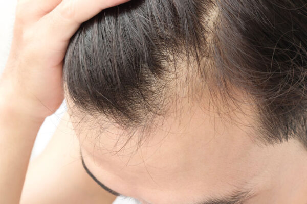 Hair Loss Treatment in Abu Dhabi