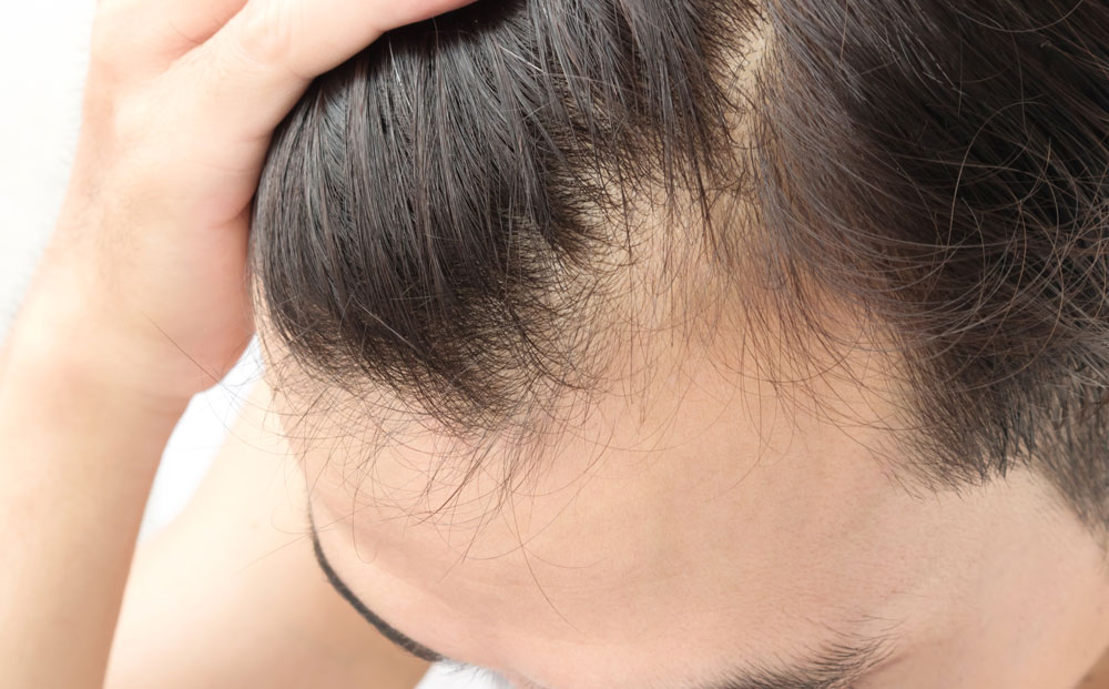 Hair Loss Treatment in Abu Dhabi