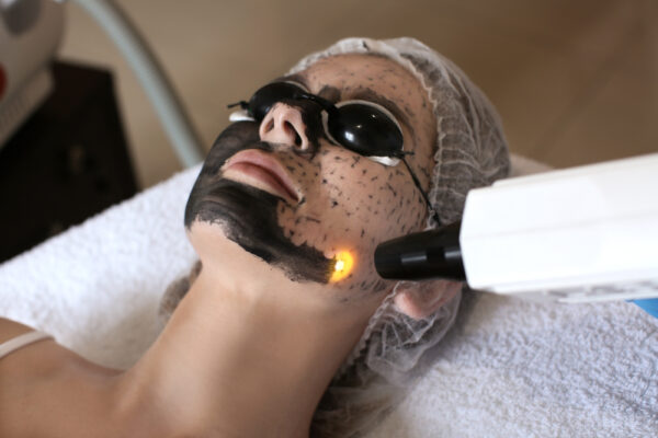 Laser Carbon Peel Abu Dhabi