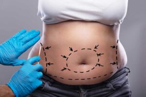 Mini Abdominoplasty Abu Dhabi