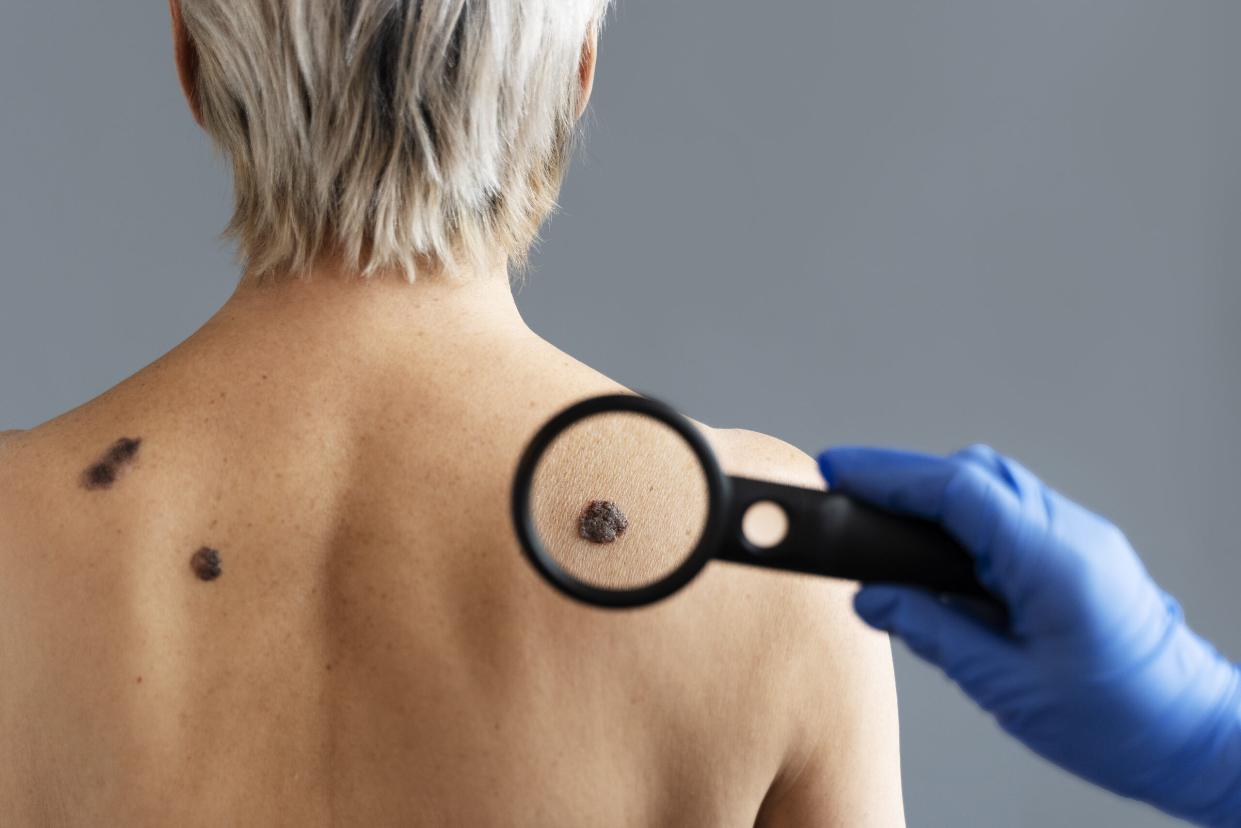 Warts Removal Treatment Abu Dhabi