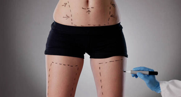 Is body lift a one time permanent surgery solution