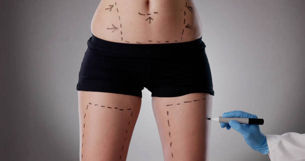 Is body lift a one time permanent surgery solution