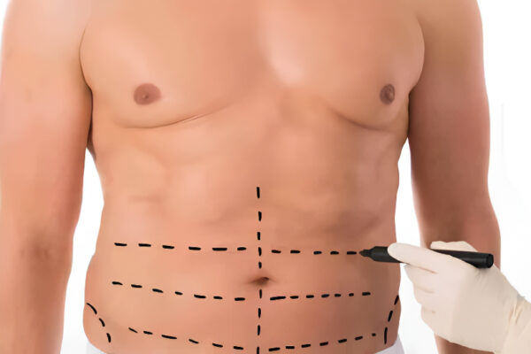 Liposuction surgery in Islamabad