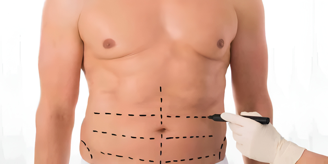 Liposuction surgery in Islamabad
