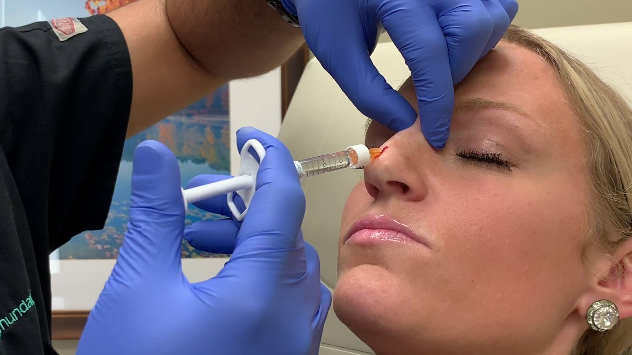 Rhinoplasty Cost in Islamabad