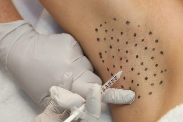 Say Goodbye to Excessive Sweating with Hyperhidrosis Treatment