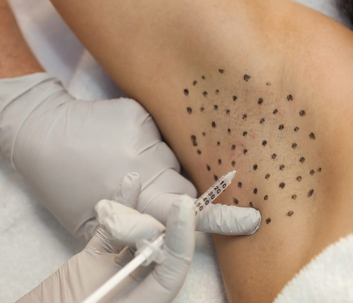 Say Goodbye to Excessive Sweating with Hyperhidrosis Treatment