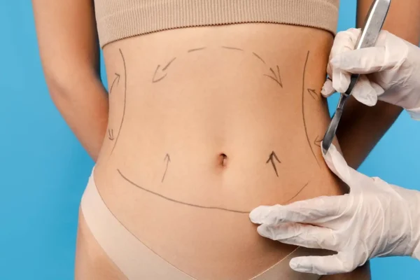 Sculpt Your Ideal Shape with Liposuction and Feel More Confident Every Day