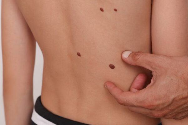 Skin Tag Removal in Islamabad