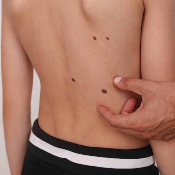 Skin Tag Removal in Islamabad