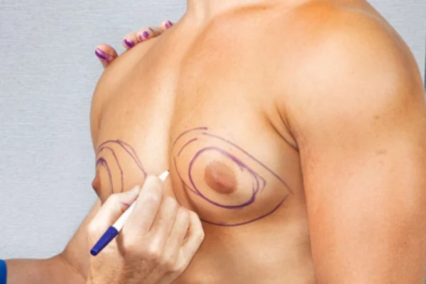 Transform Your Confidence with Gynecomastia Surgery