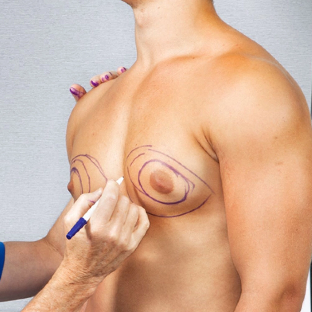 Transform Your Confidence with Gynecomastia Surgery