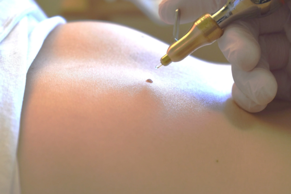 Skin Tag Removal in Abu Dhabi