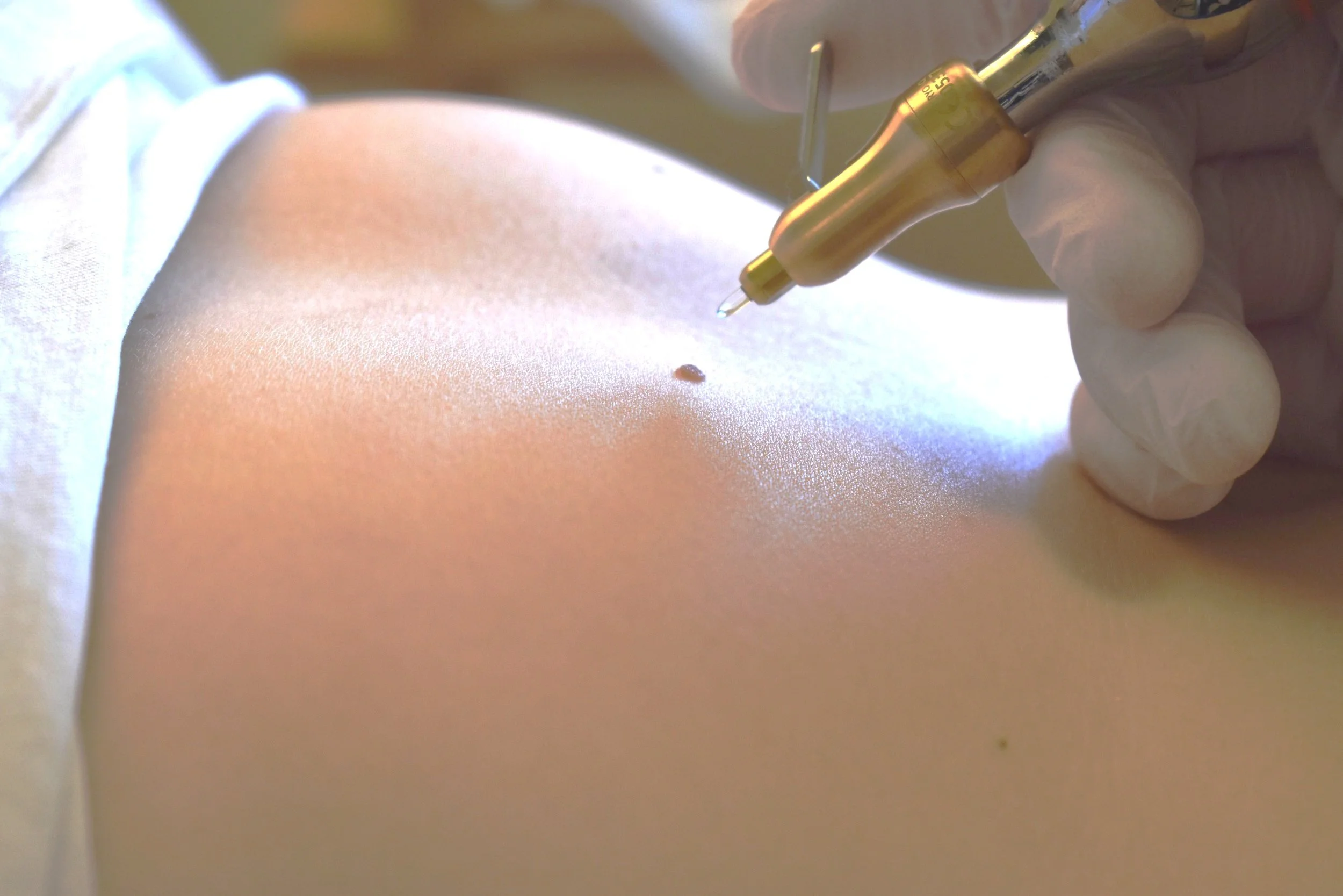 Skin Tag Removal in Abu Dhabi
