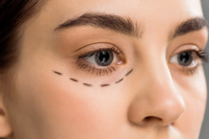 Eye Bag removal in Abu Dhabi