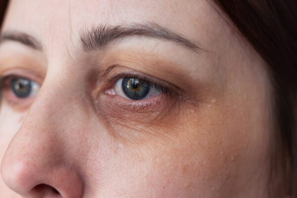 Dark Circles Treatment Abu Dhabi