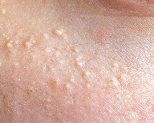 Milia Treatment in Abu Dhabi