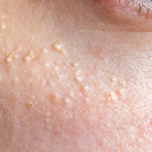 Milia Treatment in Abu Dhabi