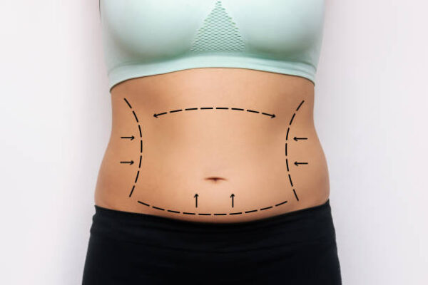 Who Is the Ideal Candidate for Liposuction Treatment
