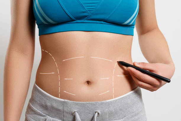 Who Is the Ideal Candidate for Tummy Tuck Today