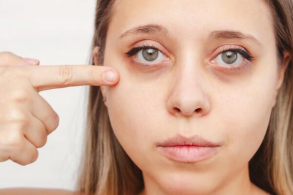 dark circles treatment