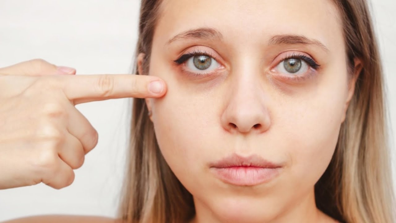 dark circles treatment