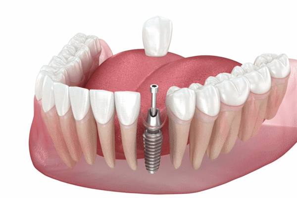 missing tooth replacement in Jamshedpur