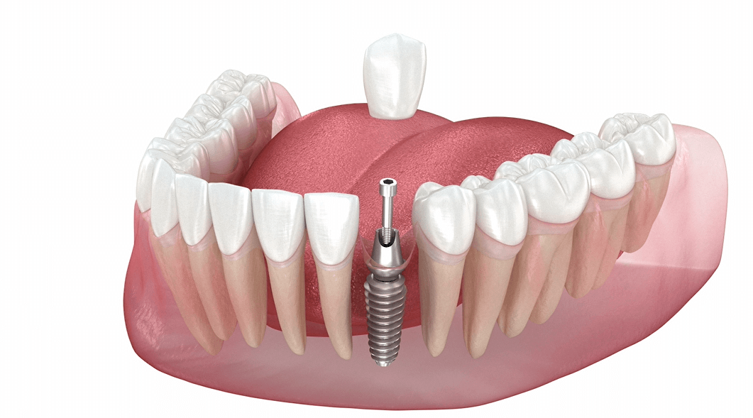 missing tooth replacement in Jamshedpur