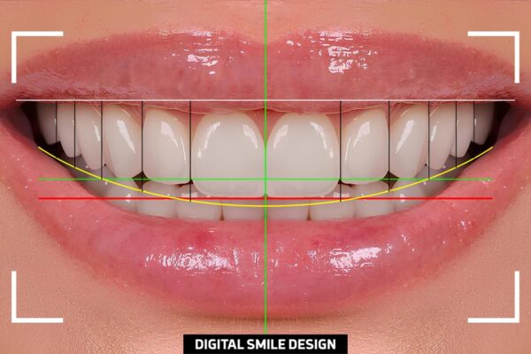 digital smile designing in hiranandani estate