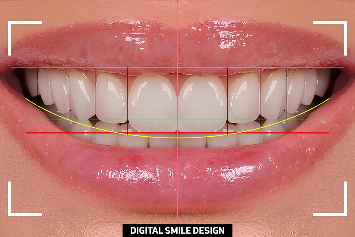 digital smile designing in hiranandani estate