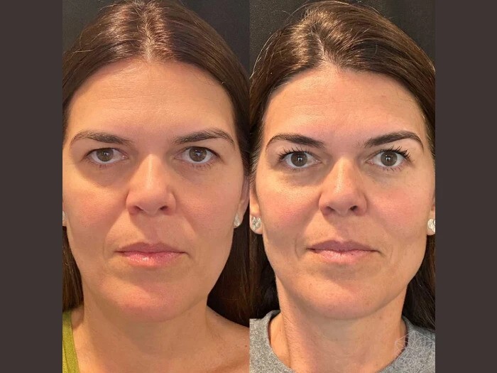 Thread Lift by Best Doctors in Dubai for Long Lasting Lift