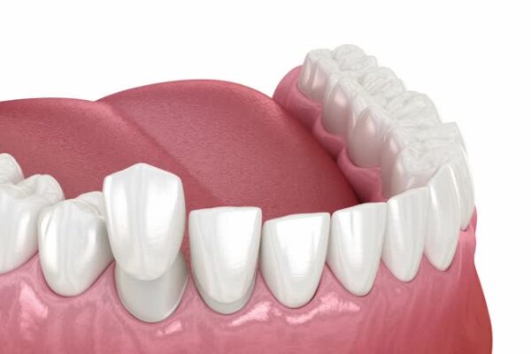 What You Can Eat and Avoid After Treatment Dental Veneers in Islamabad Pakistan: