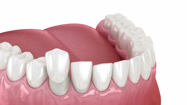 What You Can Eat and Avoid After Treatment Dental Veneers in Islamabad Pakistan: