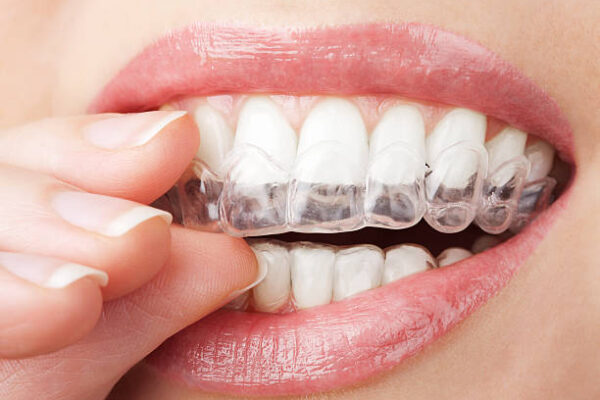 Modern Orthodontic Treatment for a Healthier, Straighter Smile Teeth Aligners in Pakistan: