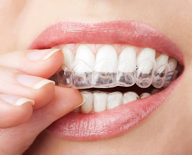 Modern Orthodontic Treatment for a Healthier, Straighter Smile Teeth Aligners in Pakistan: