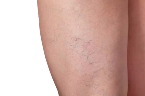 Spider Veins Treatment In Dubai