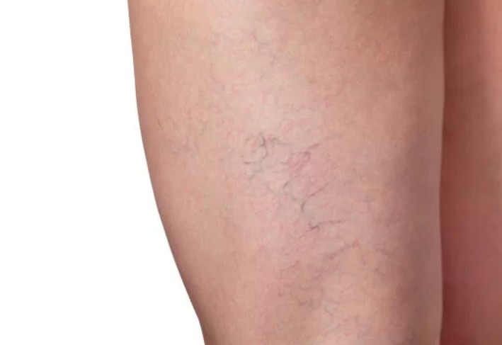 Spider Veins Treatment In Dubai