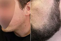 زراعة شعر اللحية في دبي